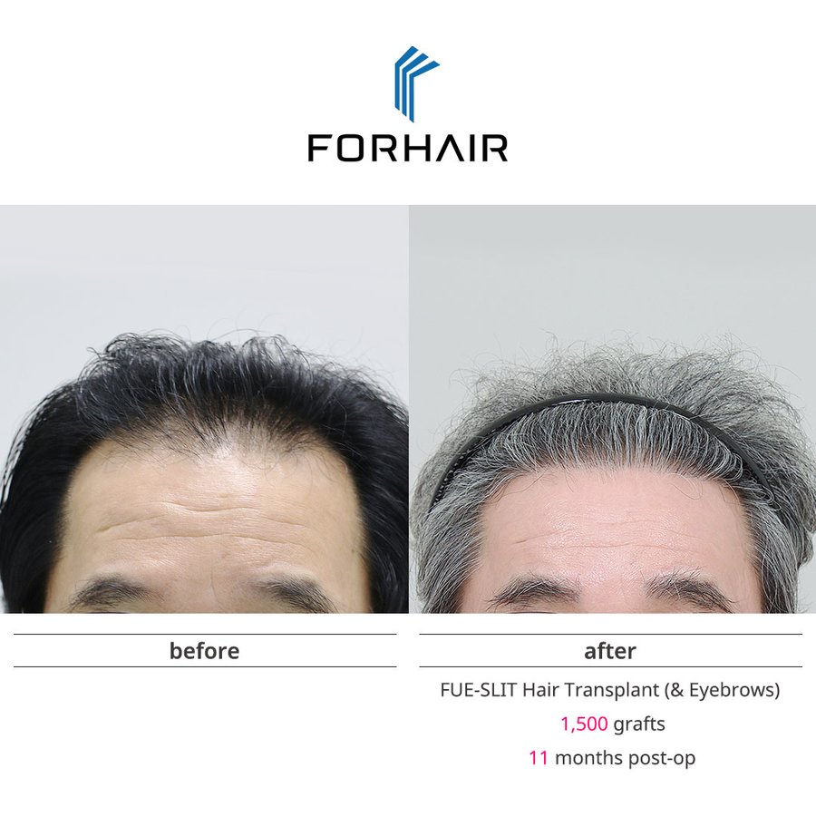 FORHAIR Hair Transplant Korea - FORHAIR Hair Transplant Korea