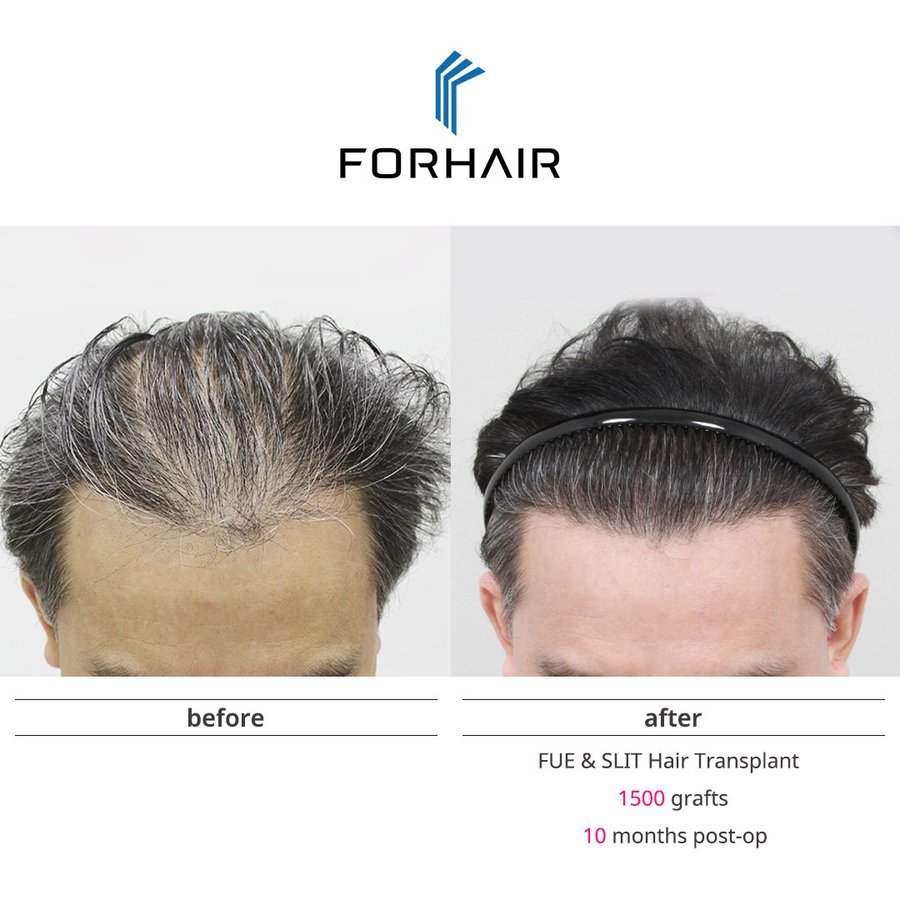 FORHAIR Hair Transplant Korea - FORHAIR Hair Transplant Korea
