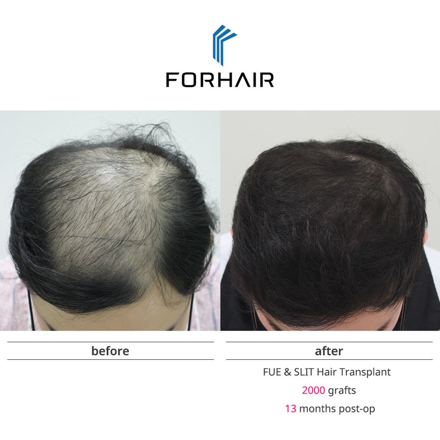 Hair Transplantation Fifth Edition（洋書） Hair Transplantation Fifth Edition（洋書）