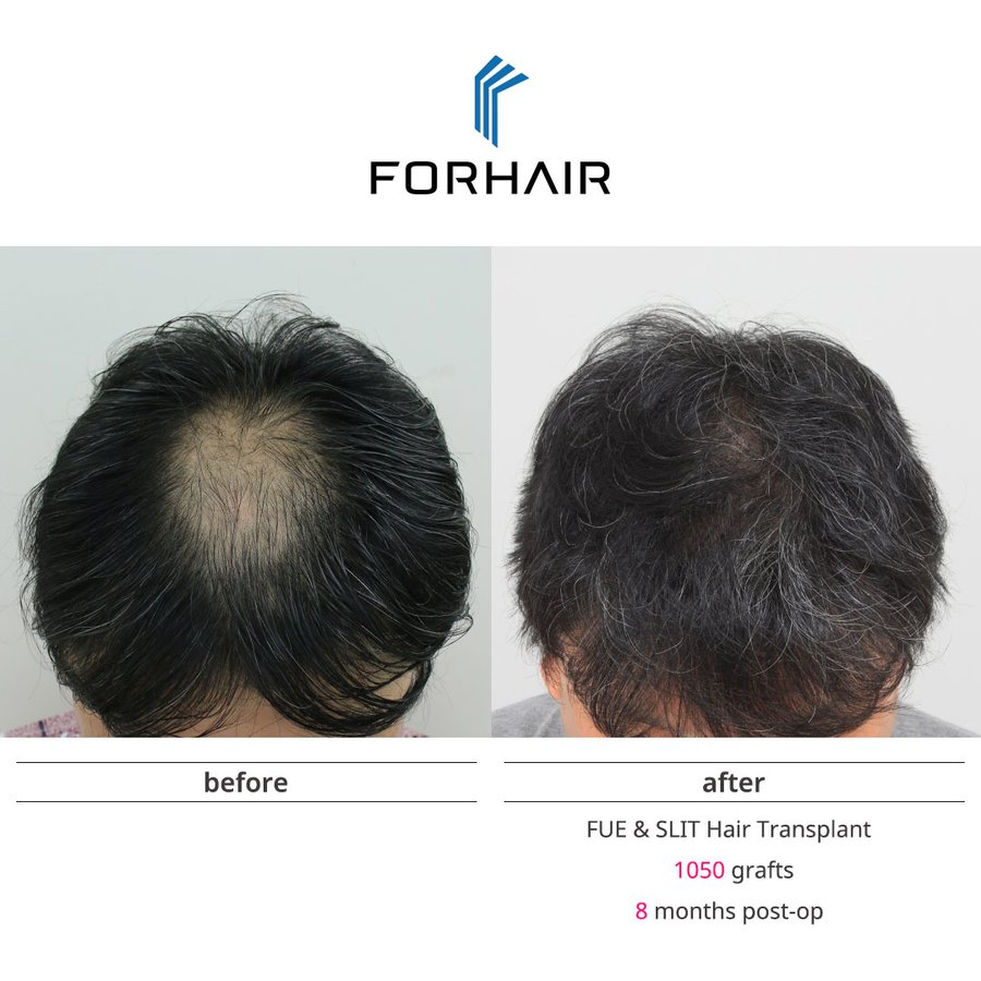 FORHAIR Hair Transplant Korea - FORHAIR Hair Transplant Korea