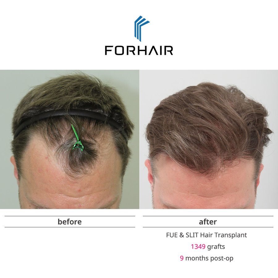 FORHAIR Hair Transplant Korea - FORHAIR Hair Transplant Korea