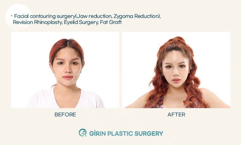Girin Plastic Surgery - Girin Plastic Surgery