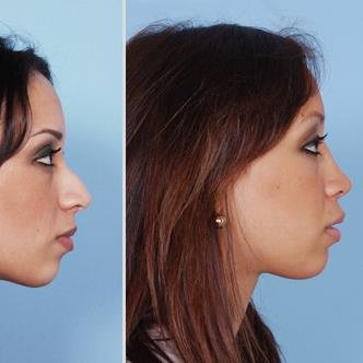 Glenn Bartlett Rhinoplasty Auckland - Glenn Bartlett Rhinoplasty Auckland