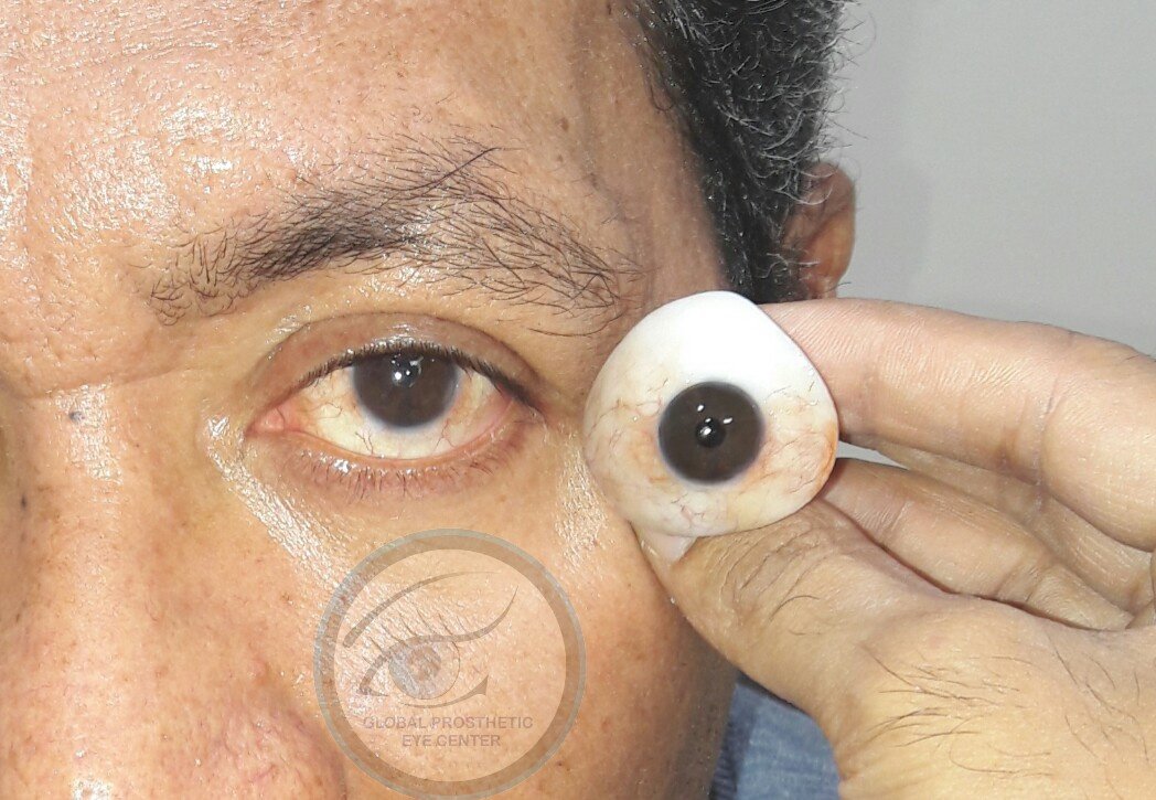Global Prosthetic Eye Center ,Delhi - Global Prosthetic Eye Center ,Delhi