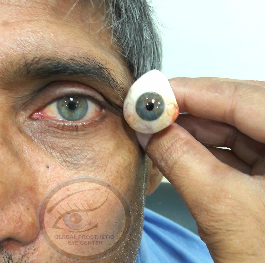 Global Prosthetic Eye Center ,Delhi - Global Prosthetic Eye Center ,Delhi