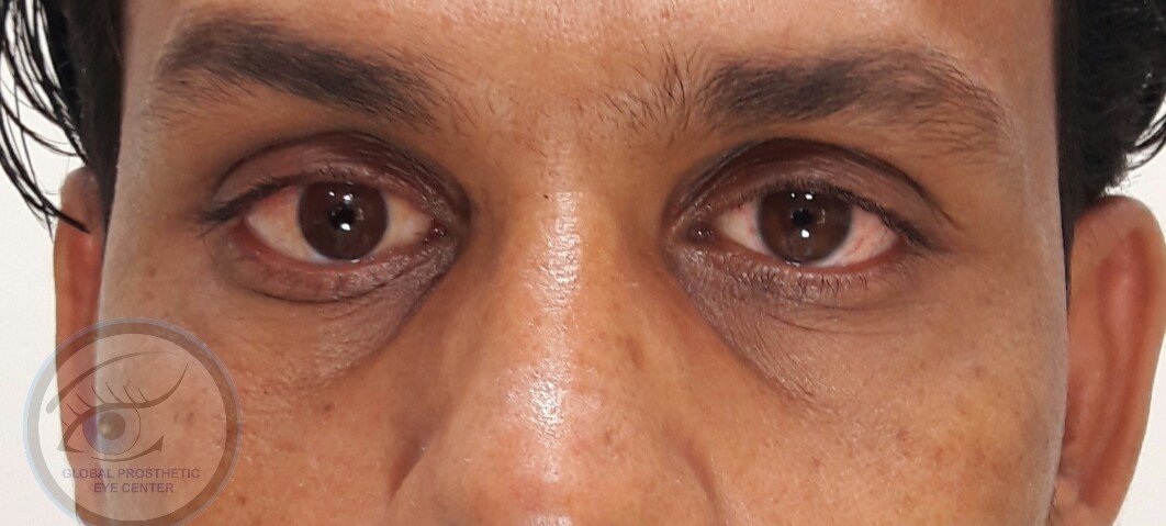 Global Prosthetic Eye Center ,Delhi - Global Prosthetic Eye Center ,Delhi