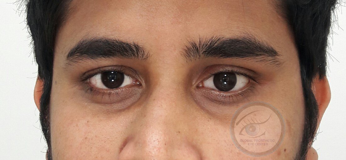 Global Prosthetic Eye Center ,Delhi - Global Prosthetic Eye Center ,Delhi