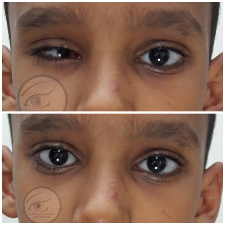 Global Prosthetic Eye Center ,Delhi - Global Prosthetic Eye Center ,Delhi