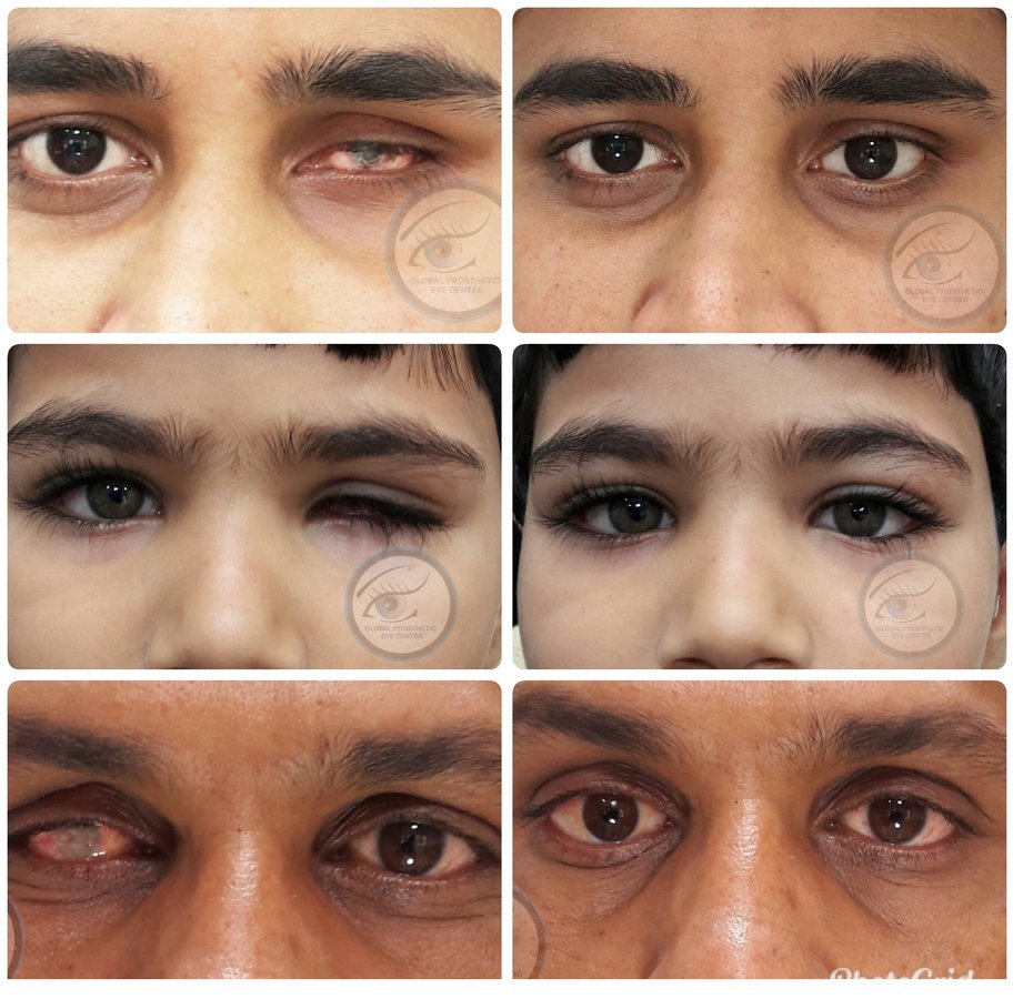 Global Prosthetic Eye Center ,Delhi - Global Prosthetic Eye Center ,Delhi
