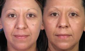 عيادة لامعة للبشرة والشعر - Ahmadabad - Gloss Skin and Hair Clinic - Ahmadabad