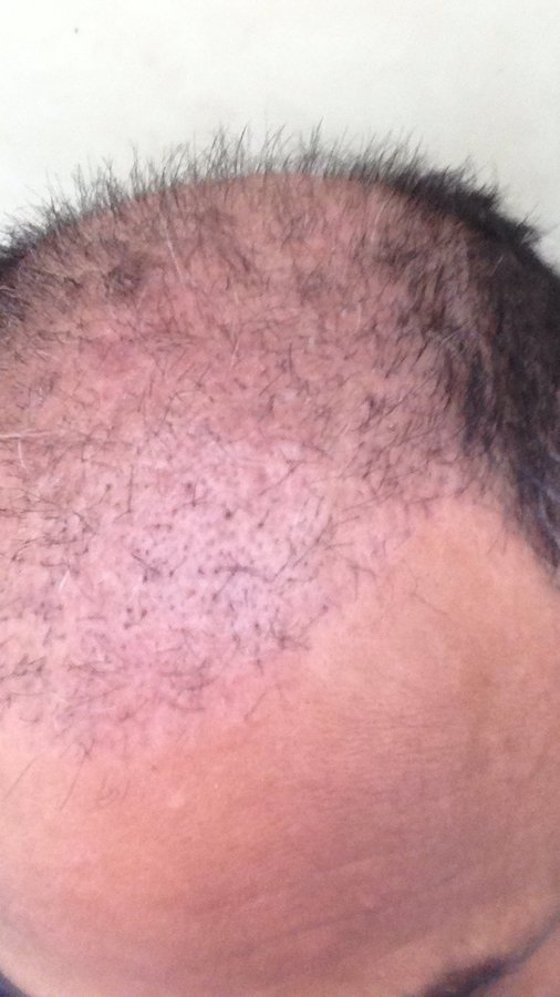 Gür Hair Transplant Centre - Gür Hair Transplant Centre