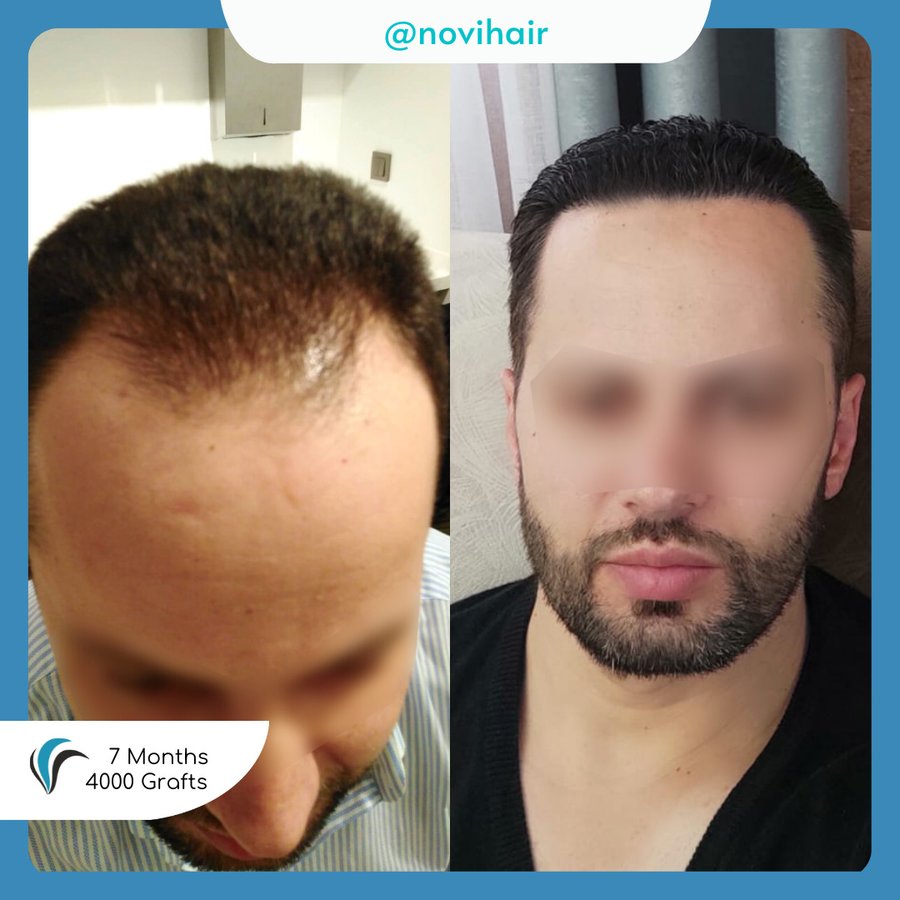 الشعر Avrasya - Hair Avrasya