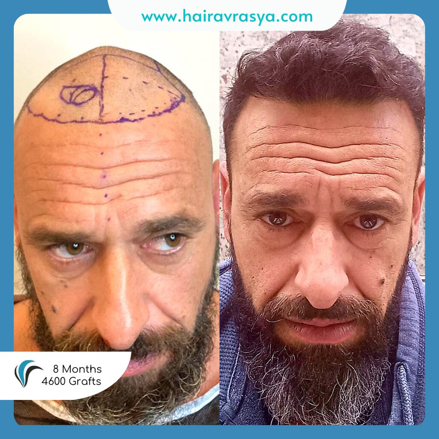 الشعر Avrasya - Hair Avrasya