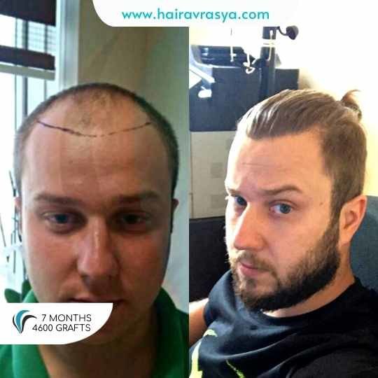 الشعر Avrasya - Hair Avrasya