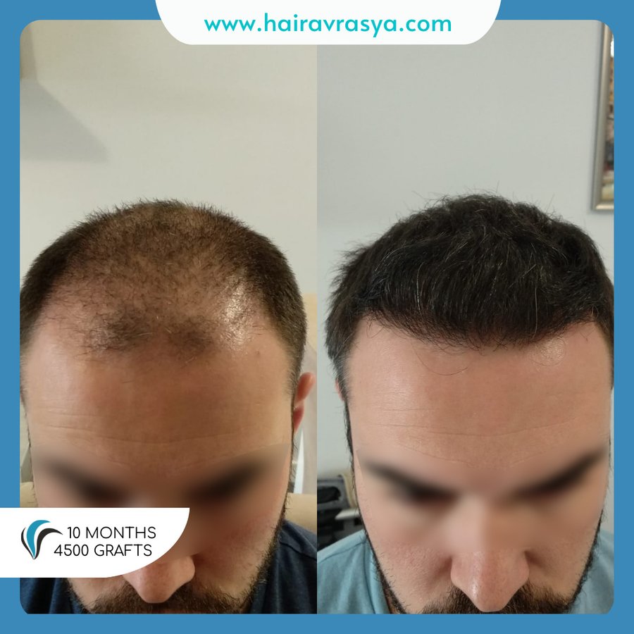 الشعر Avrasya - Hair Avrasya