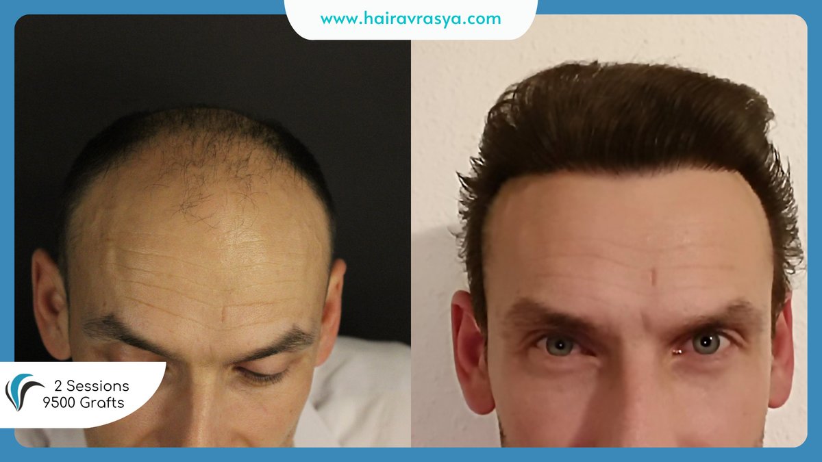 الشعر Avrasya - Hair Avrasya