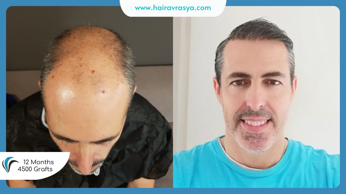 الشعر Avrasya - Hair Avrasya