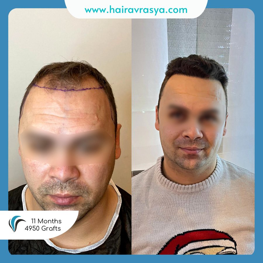 الشعر Avrasya - Hair Avrasya