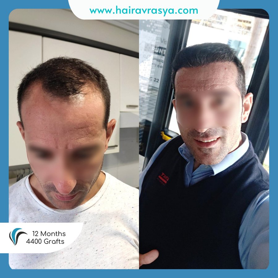 الشعر Avrasya - Hair Avrasya
