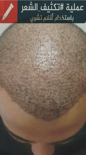 Hair Care Turkey - Hair Care Turkey