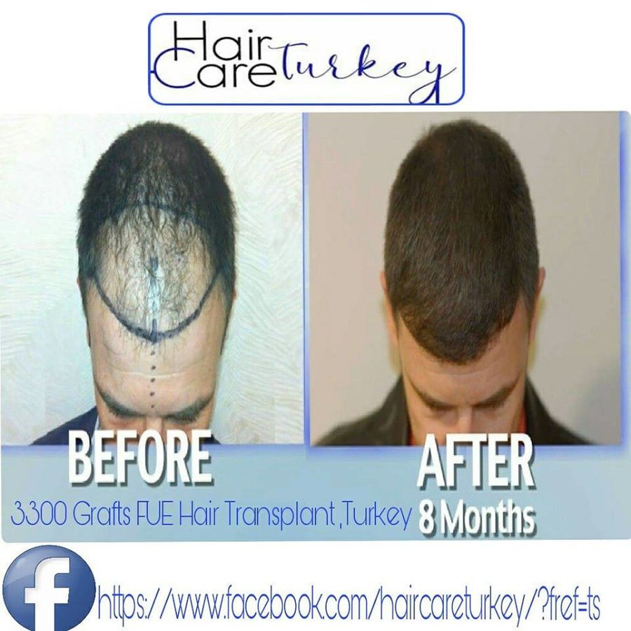 Hair Care Turkey - Hair Care Turkey