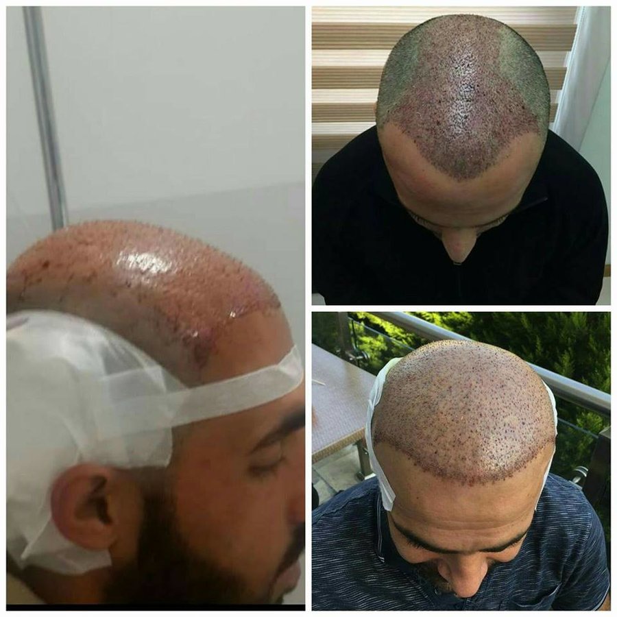 Hair Care Turkey - Hair Care Turkey