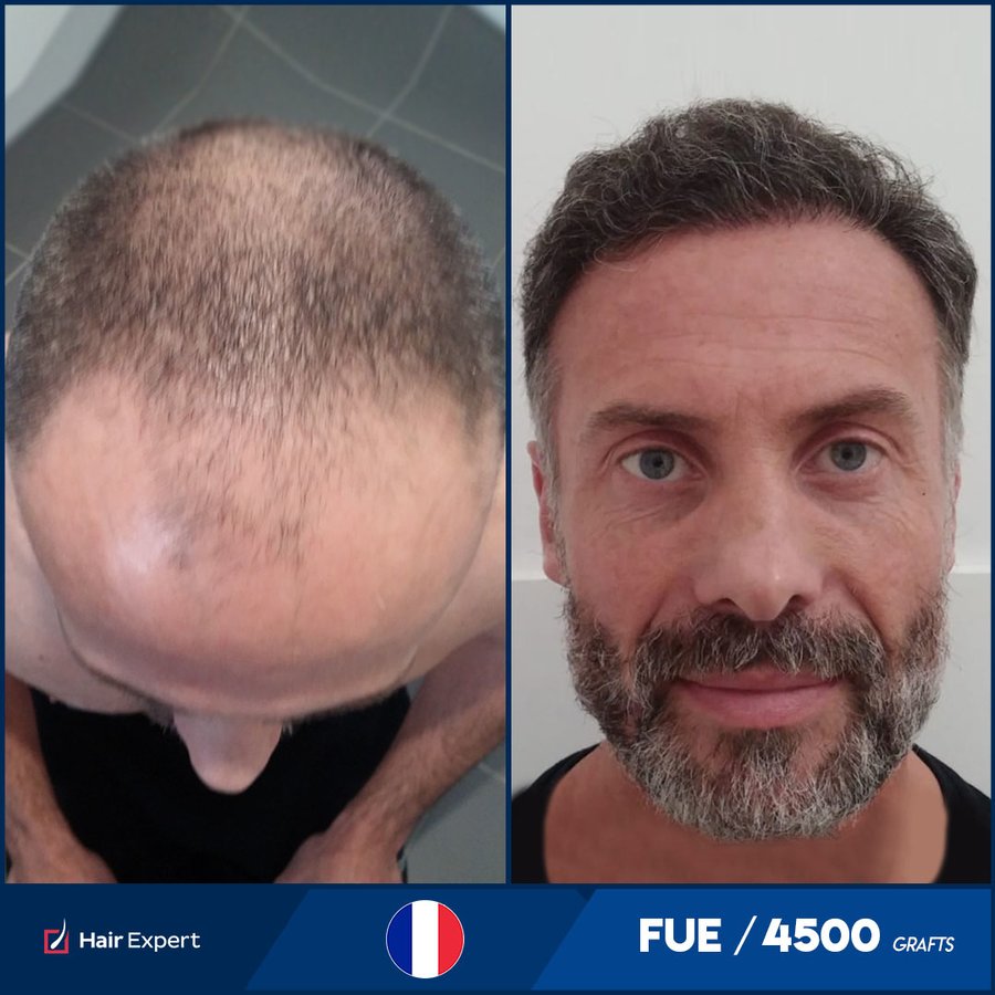 Hair Expert International Hair Transplant Complex - Hair Expert International Hair Transplant Complex