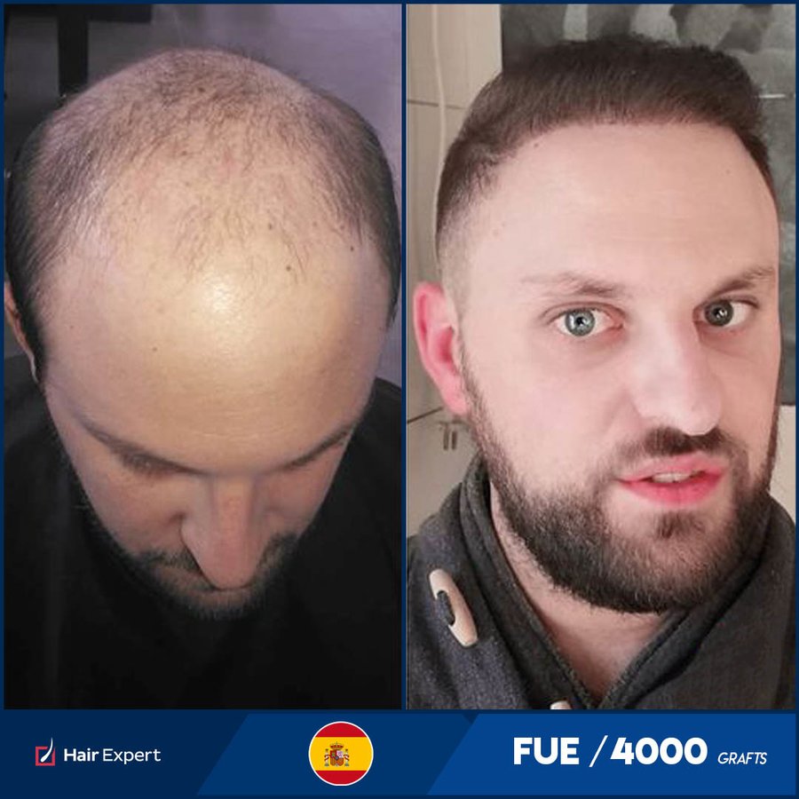 Hair Expert International Hair Transplant Complex - Hair Expert International Hair Transplant Complex