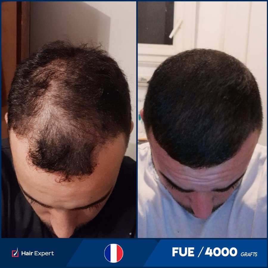 Hair Expert International Hair Transplant Complex - Hair Expert International Hair Transplant Complex