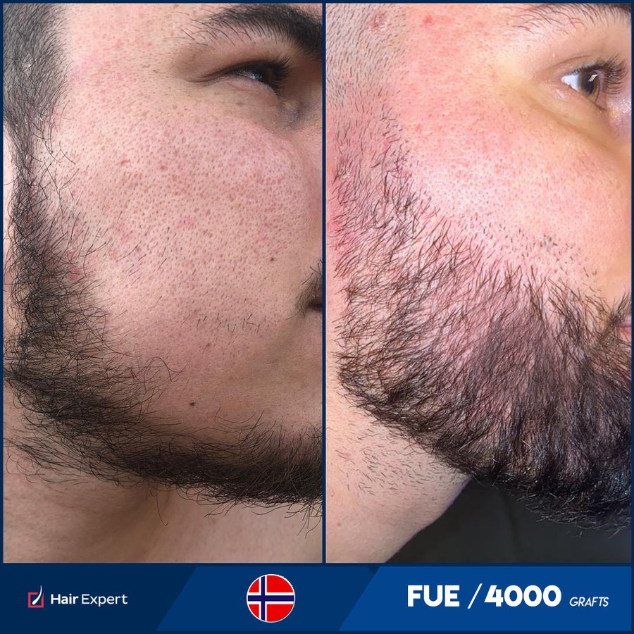 Hair Expert International Hair Transplant Complex - Hair Expert International Hair Transplant Complex