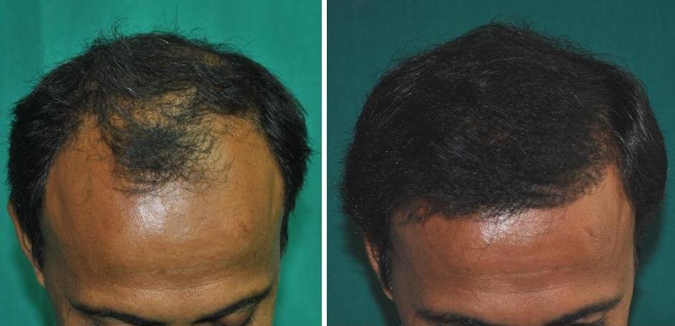 Hair İmplantation İstanbul - Hair İmplantation İstanbul