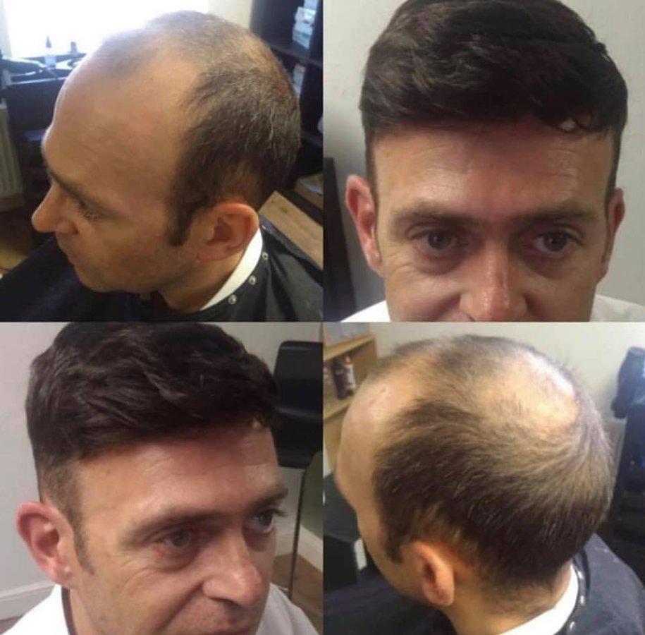 عيادة تساقط الشعر - Chester & Wirral - Hair Loss Clinic - Chester & Wirral