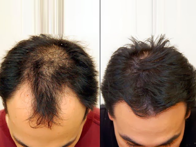 عيادة تساقط الشعر - وارينغتون - Hair Loss Clinic - Warrington