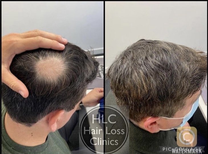 عيادة تساقط الشعر - وارينغتون - Hair Loss Clinic - Warrington