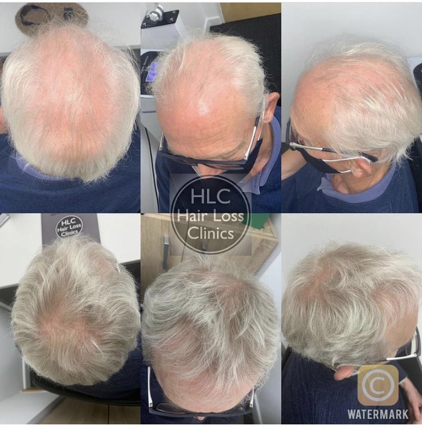 عيادة تساقط الشعر - وارينغتون - Hair Loss Clinic - Warrington