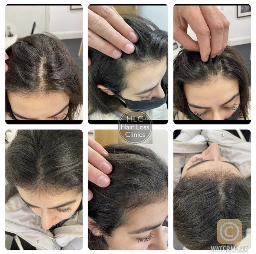 عيادة تساقط الشعر - وارينغتون - Hair Loss Clinic - Warrington