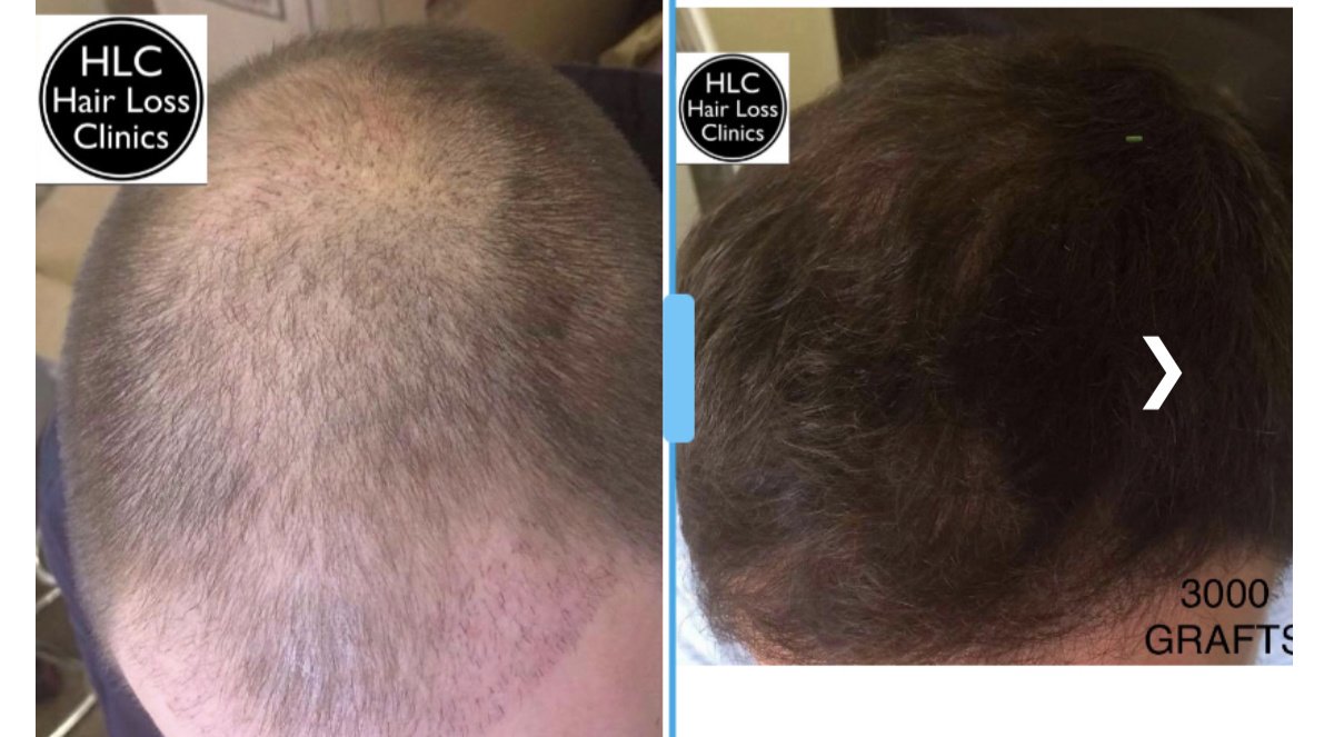 عيادة تساقط الشعر - وارينغتون - Hair Loss Clinic - Warrington