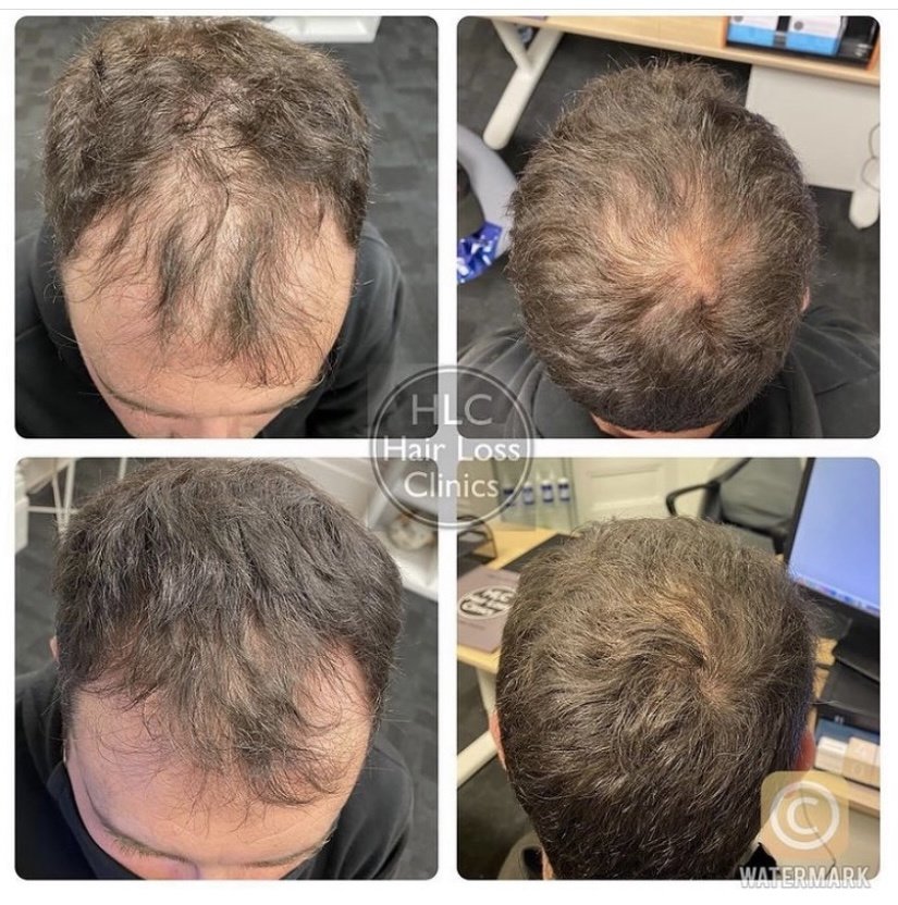 عيادة تساقط الشعر - وارينغتون - Hair Loss Clinic - Warrington