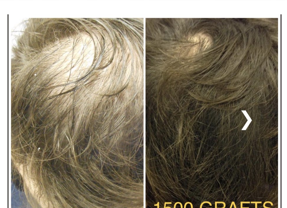 عيادة تساقط الشعر - وارينغتون - Hair Loss Clinic - Warrington