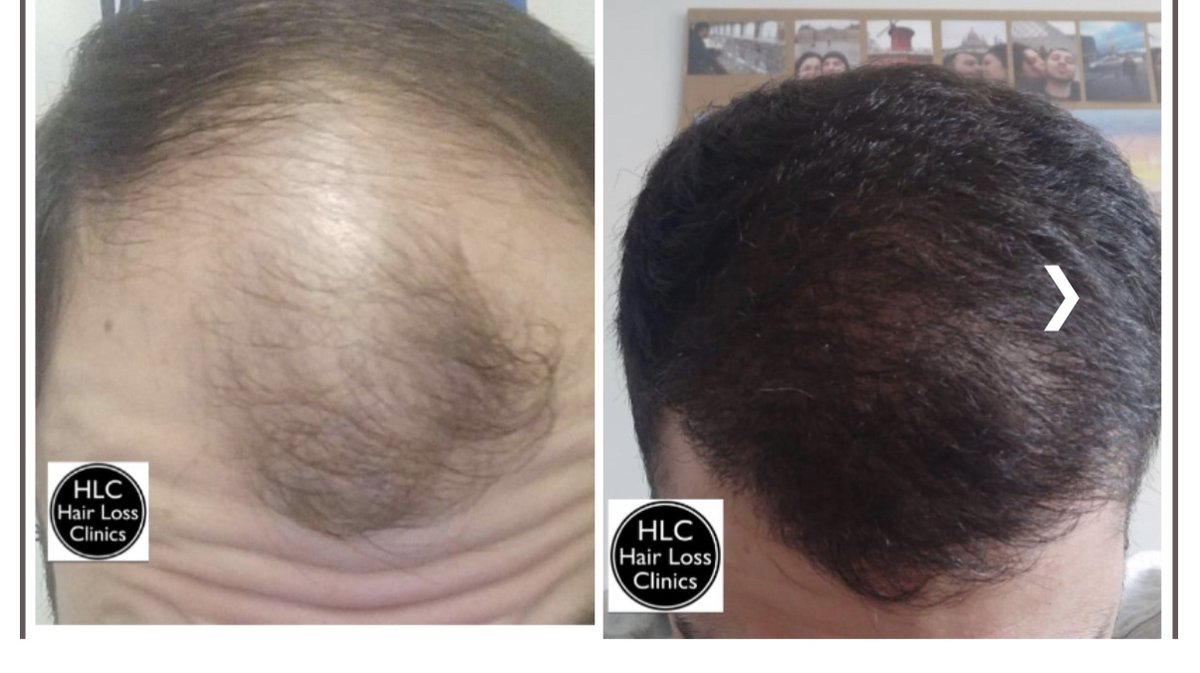 عيادة تساقط الشعر - وارينغتون - Hair Loss Clinic - Warrington