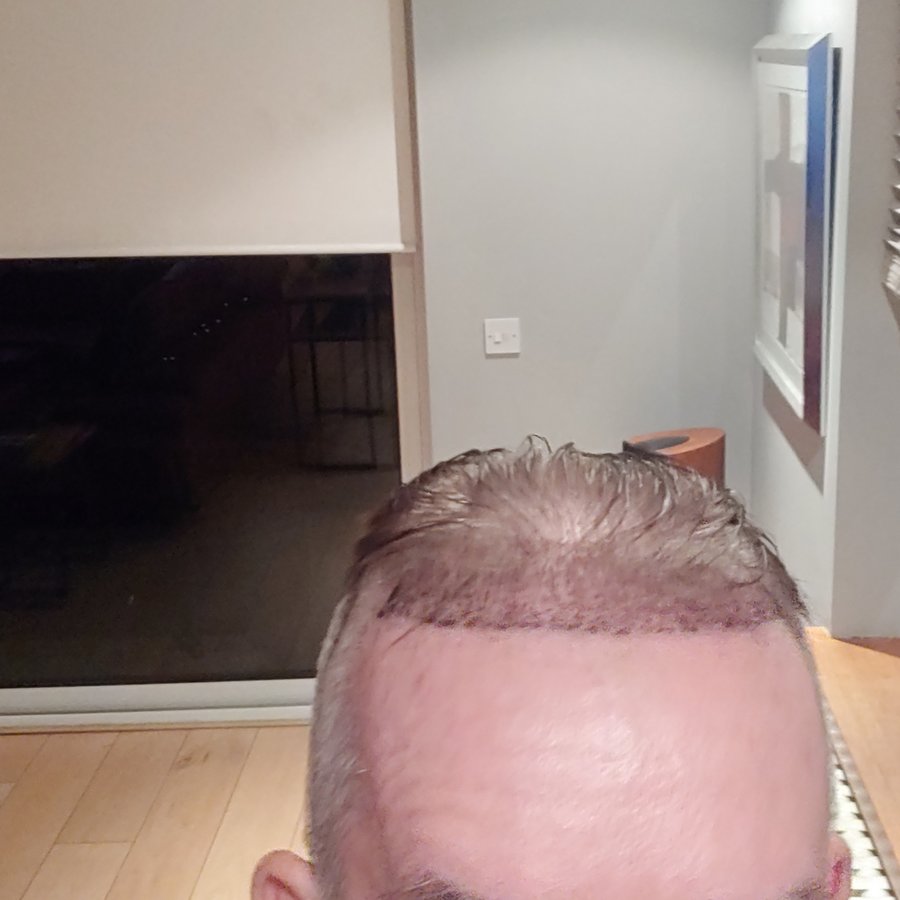 Hair Neva Hair Transplant Center - Hair Neva Hair Transplant Center