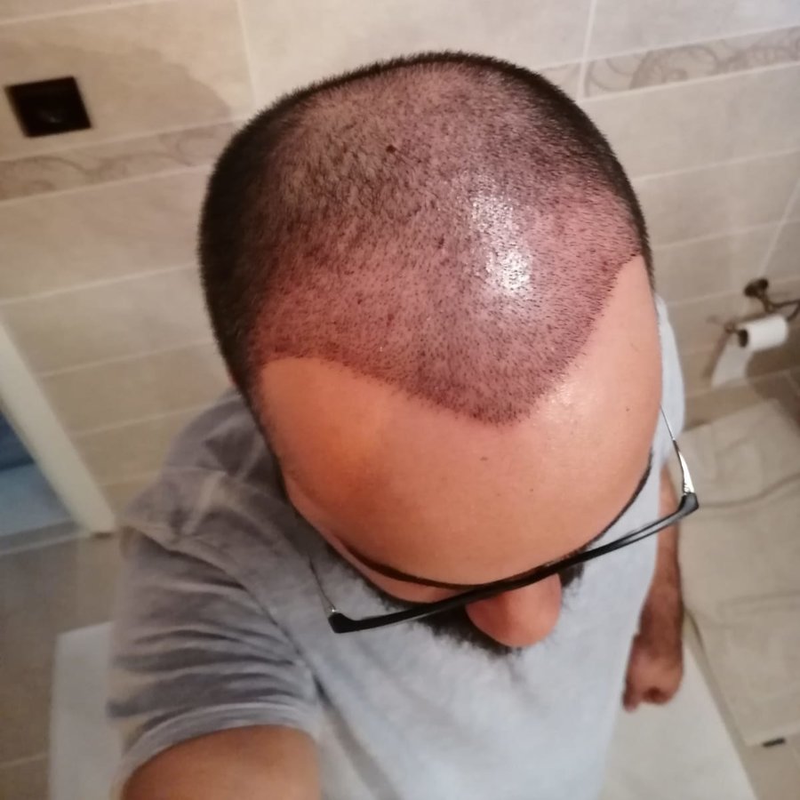 Hair Neva Hair Transplant Center - Hair Neva Hair Transplant Center