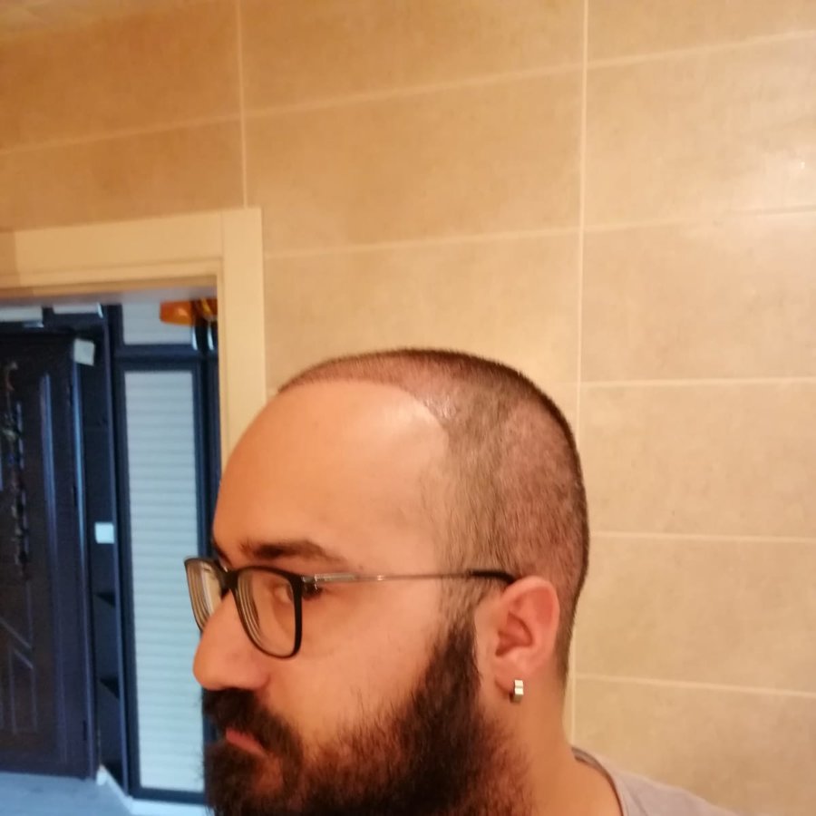 Hair Neva Hair Transplant Center - Hair Neva Hair Transplant Center