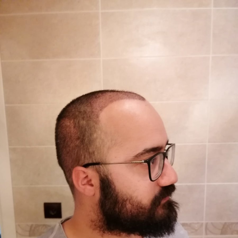 Hair Neva Hair Transplant Center - Hair Neva Hair Transplant Center