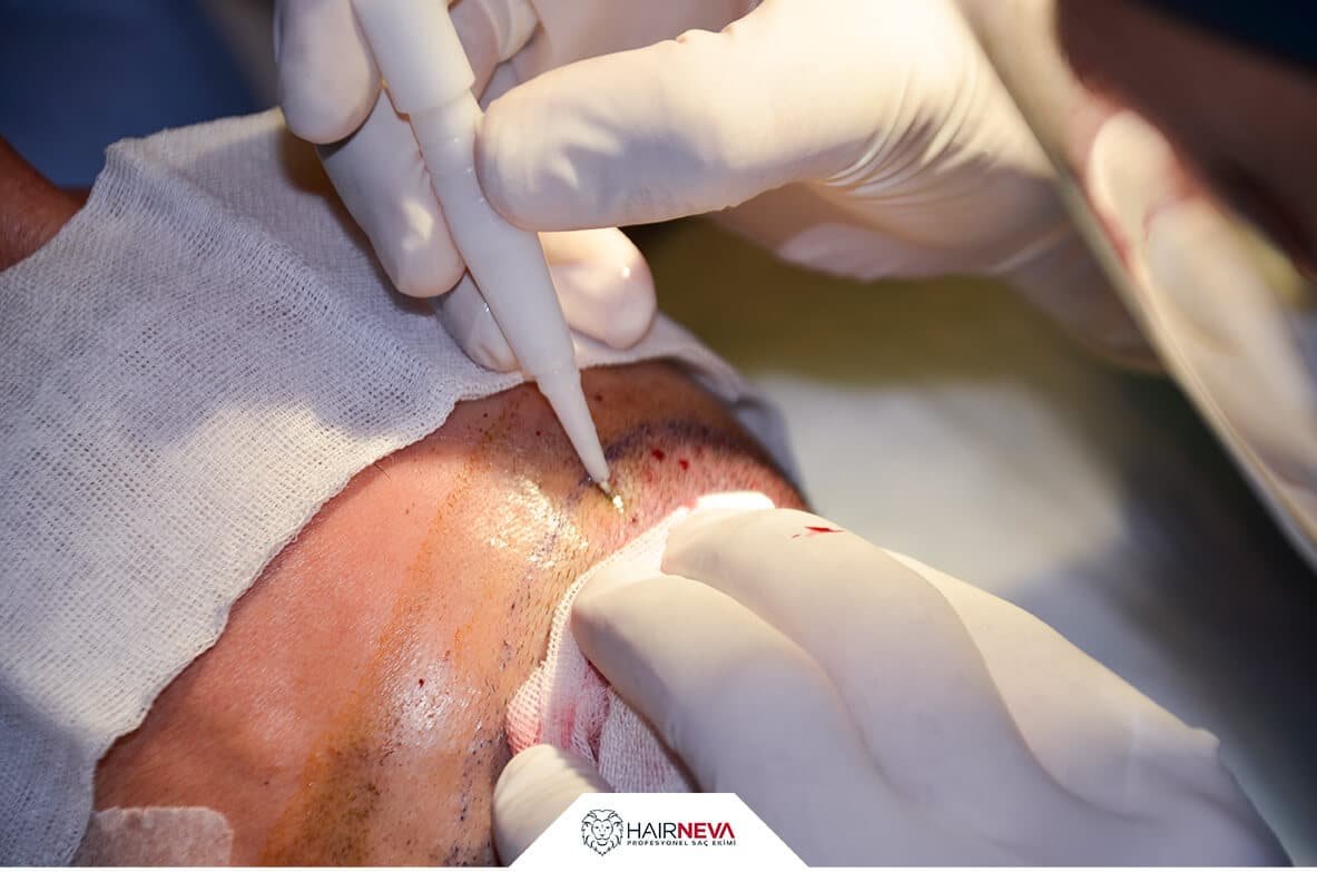 Hair Neva Hair Transplant Center - Hair Neva Hair Transplant Center