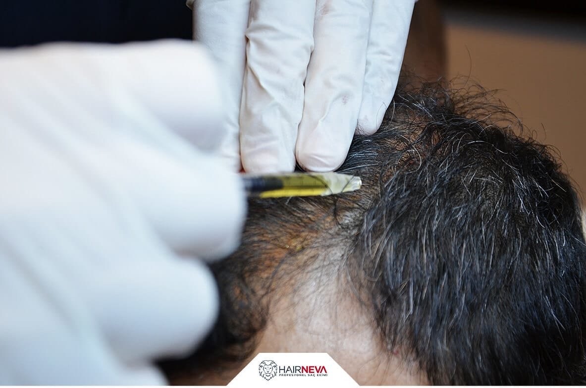 Hair Neva Hair Transplant Center - Hair Neva Hair Transplant Center