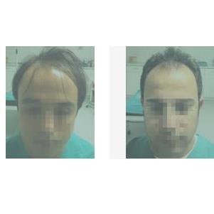 Hair Trans - Hair Trans