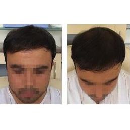 Hair Trans - Hair Trans