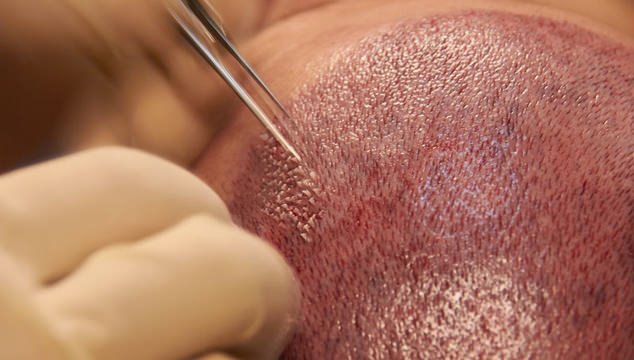 عيادة هير ترانسلاند - Hair Transland Clinic