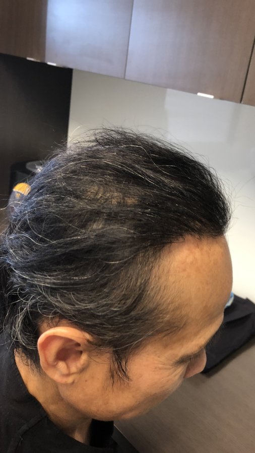 Hair Transplant Australia - Hair Transplant Australia